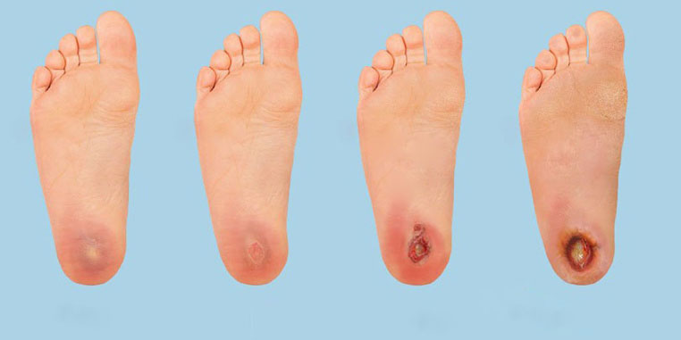 Diabetic Foot Care - OCFeet.com