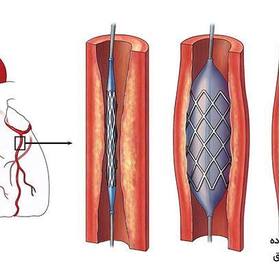 آنژیوگرافی عروق کرونر در تهران