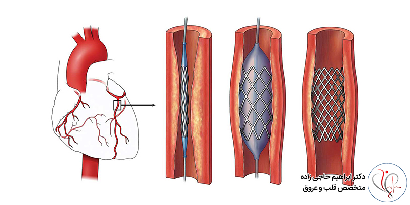 آنژیوگرافی عروق کرونر در تهران