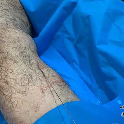 درمان واریس با لیزر در تهران