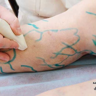 لیزر واریس پا