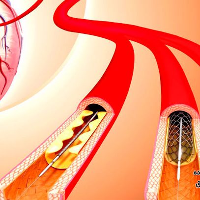 استنت گذاری قلب در تهران