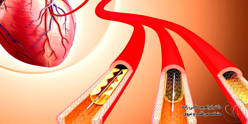 استنت گذاری قلب در تهران