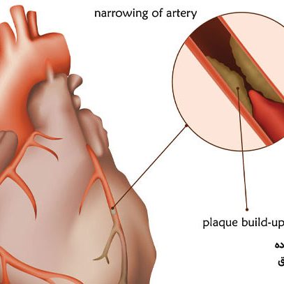 بیماری های ناشی از گرفتگی عروق کرونر