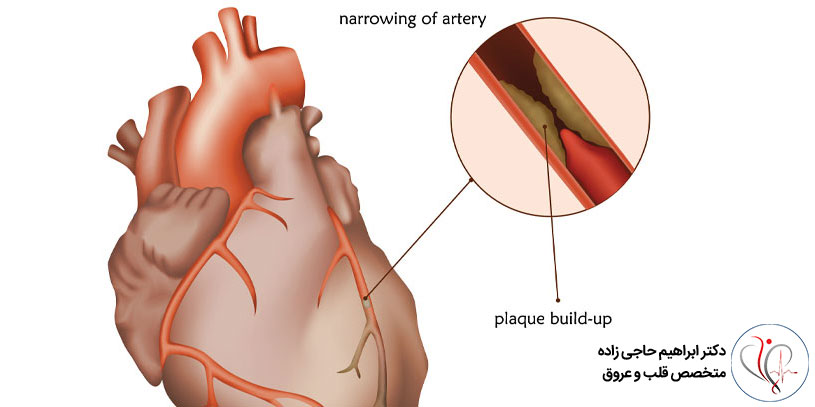 بیماری های ناشی از گرفتگی عروق کرونر