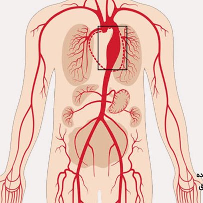 بیماری آنوریسم آئورت قفسه سینه