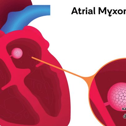 میگزوم قلبی چیست