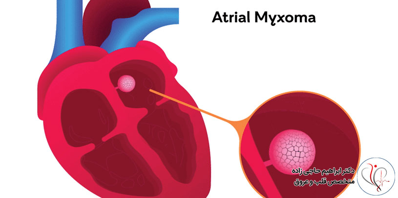 میگزوم قلبی چیست