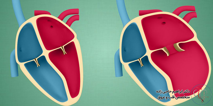 کاردیومیوپاتی چیست