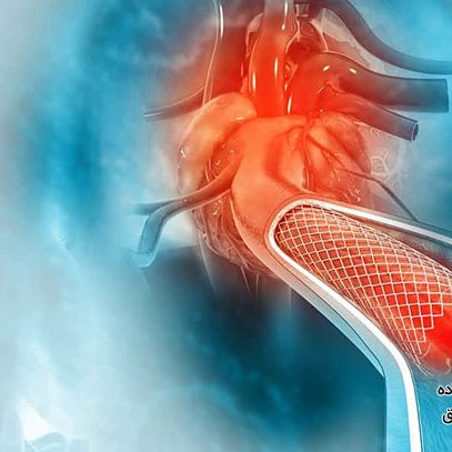 آنژیوپلاستی عروق قلبی در تهران