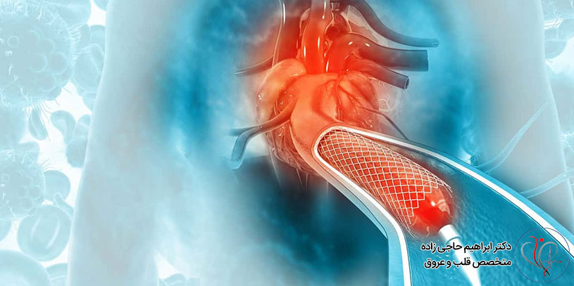 Cardiovascular-angioplasty-in-Tehran-2 آنژیوپلاستی عروق قلبی در تهران