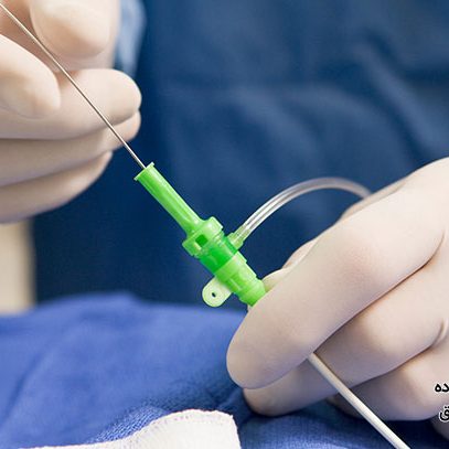 آنژیوگرافی قلب از طریق دست در تهران