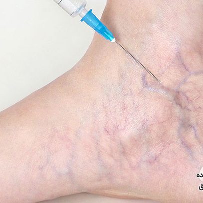 اسکلروتراپی واریس در تهران