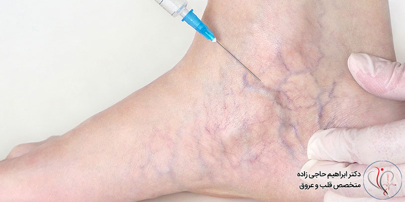 اسکلروتراپی واریس در تهران