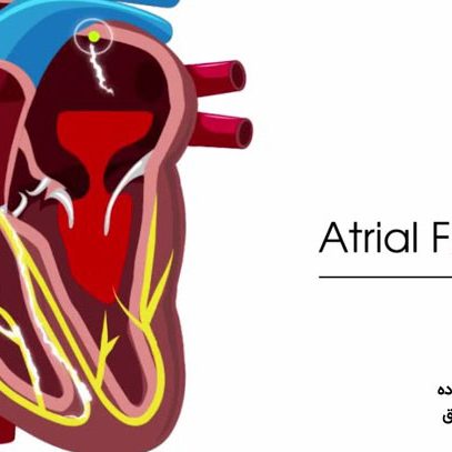 ارتباط فیبریلاسیون دهلیزی و سکته قلبی
