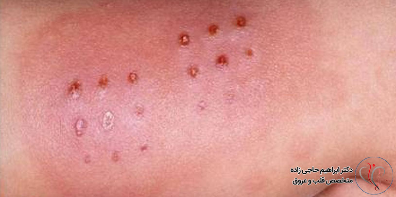 عوارض بیماری کاوازاکی