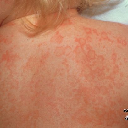 عوارض بیماری کاوازاکی