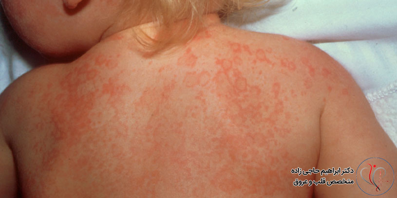 عوارض بیماری کاوازاکی