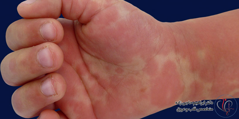 عوارض بیماری کاوازاکی