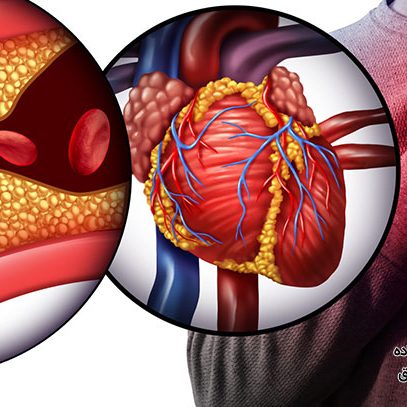 آنژین قلبی چیست