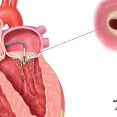 عوارض ناشی از گشادی دریچه قلب