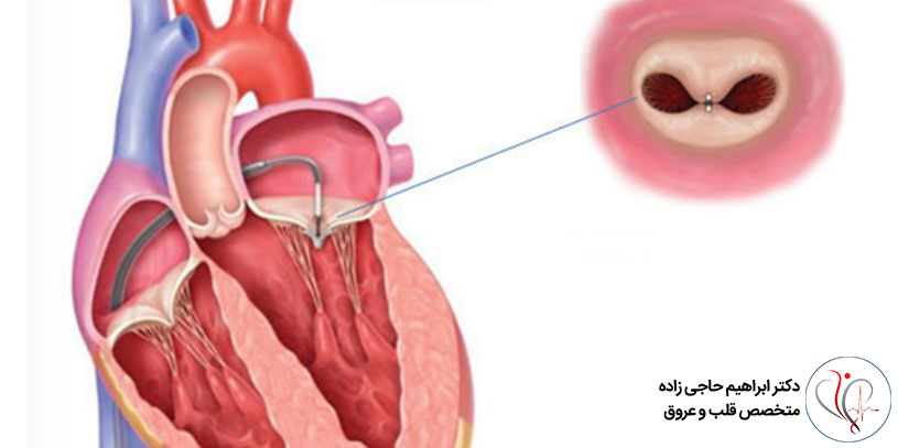 عوارض ناشی از گشادی دریچه قلب