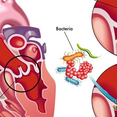 خطرات ناشی از اندوکاردیت عفونی