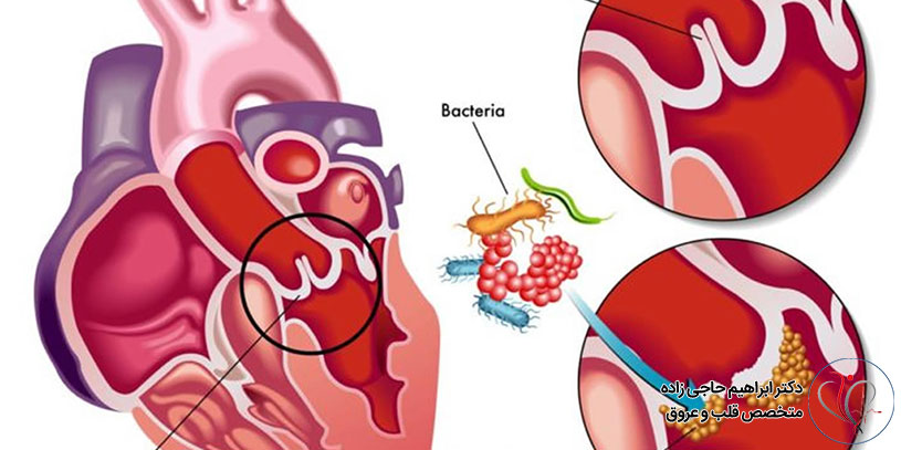 خطرات ناشی از اندوکاردیت عفونی