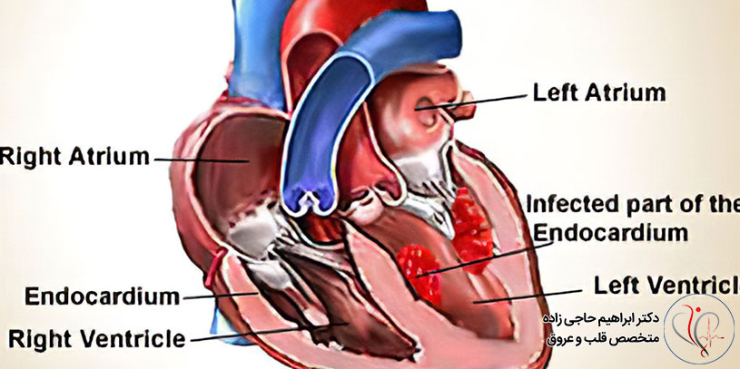 خطرات ناشی از اندوکاردیت عفونی