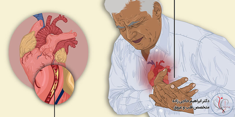 اسپاسم عروق کرونری قلب چیست