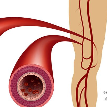 آنژیوپلاستی گرفتگی عروق پا