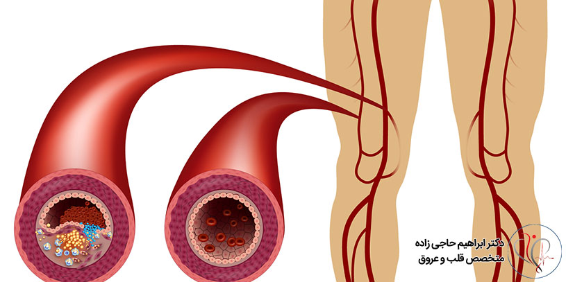آنژیوپلاستی گرفتگی عروق پا