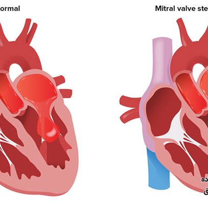 علت تنگی دریچه میترال
