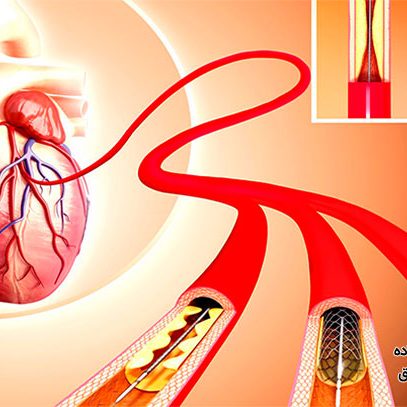 چه کسانی به آنژیوپلاستی نیاز دارند