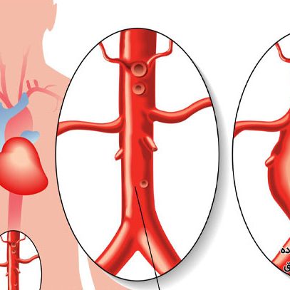 روش های درمان آنوریسم قلبی