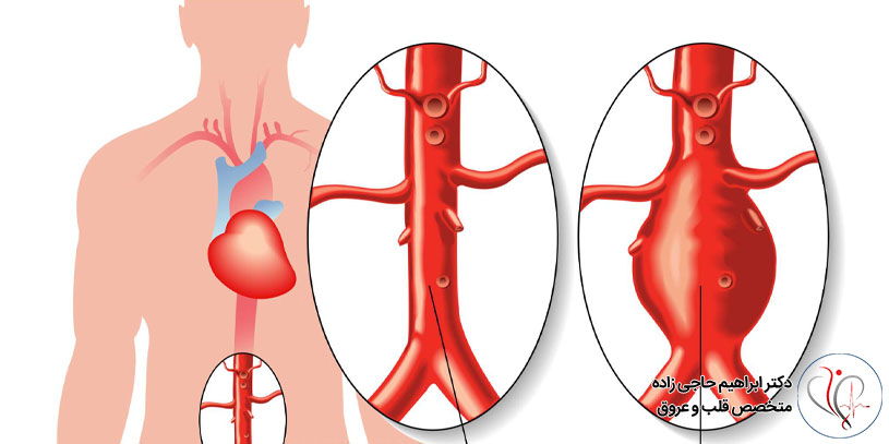 روش های درمان آنوریسم قلبی