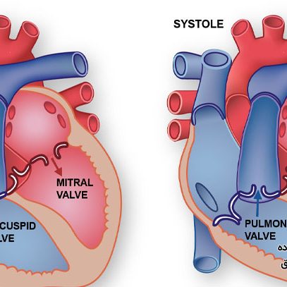 علائم و علل نارسایی دریچه آئورت
