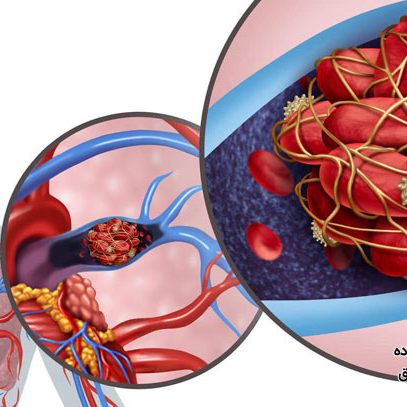 آشنایی با انواع لخته های خونی