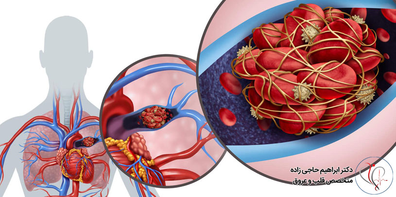 آشنایی با انواع لخته های خونی