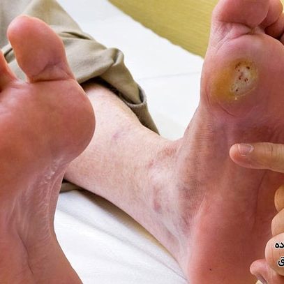 درمان زخم پای دیابتی