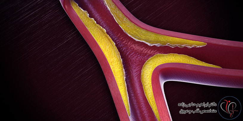 آترواسکلروز یا تصلب شرایین چیست
