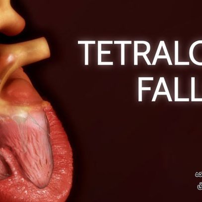 همه چیز درباره بیماری تترالوژی فالوت