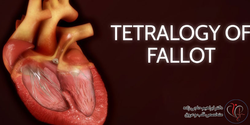 همه چیز درباره بیماری تترالوژی فالوت