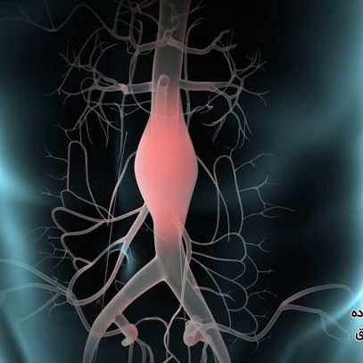 جراحی آنوریسم آئورت شکمی
