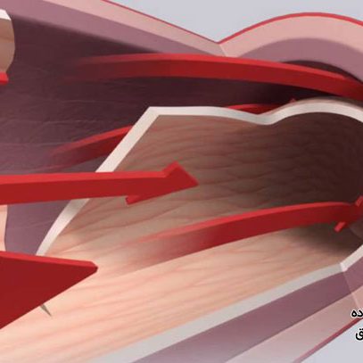 همه چیز درباره عروق کرونر غیر عادی یا ACA