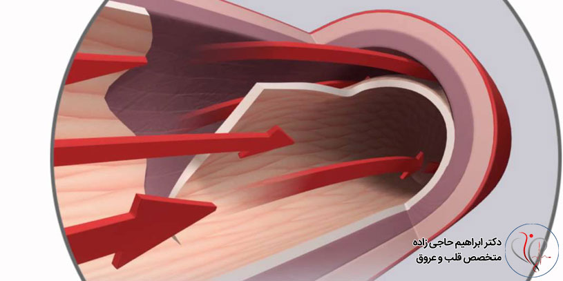 همه چیز درباره عروق کرونر غیر عادی یا ACA