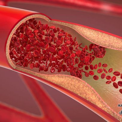 جلوگیری از لخته شدن خون با مواد طبیعی