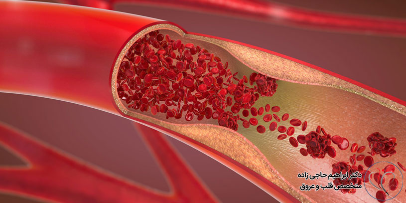 جلوگیری از لخته شدن خون با مواد طبیعی