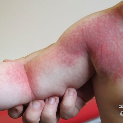 سندرم کلیپل ترنونه چیست