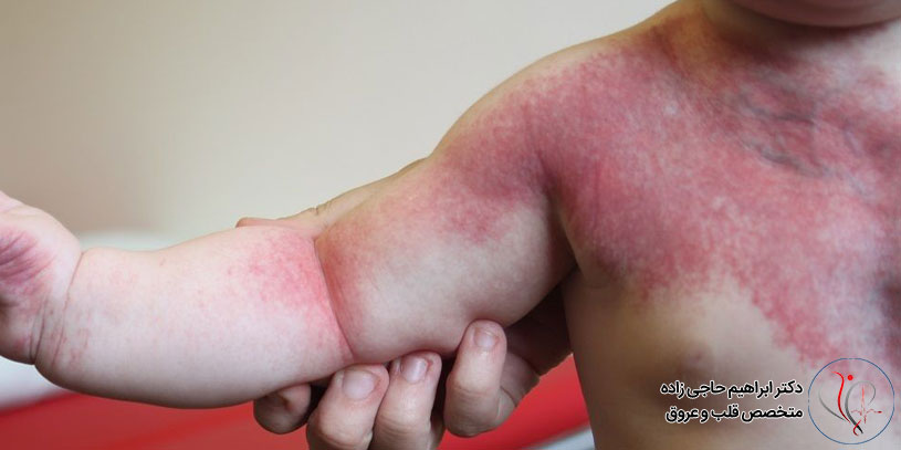 سندرم کلیپل ترنونه چیست